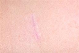 Rib harvest scar at 8 weeks, zoomed in.