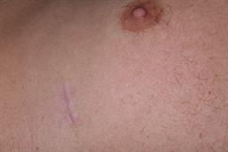 Rib harvest scar at 8 weeks